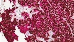 МЕТАСТАСТАТИЧЕСКОЕ ПОРАЖЕНИЕ ЖЕЛУДКА И ДВЕНАДЦАТИПЕРСТНОЙ КИШКИ