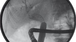 Классификация перфораций двенадцатиперстной кишки, связанных с выполнением эндоскопических транспапиллярных вмешательств по Стапфер (Stapfer M), 2000