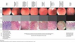 К ЭНДОСКОПИЧЕСКОЙ КЛАССИФИКАЦИИ ХРОНИЧЕСКИХ ГАСТРИТОВ