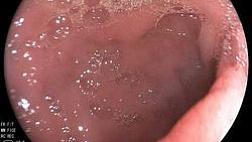 Дуоденальная дистрофия - гетеротопия ткани поджелудочной железы в стенку ДПК. Groove pancreatit.