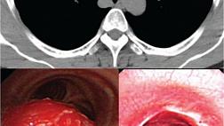 ГЛОМУСНАЯ ОПУХОЛЬ ТРАХЕИ