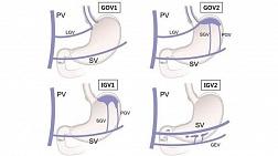 Cхема венозного оттока от вен пищевода и желудка и соответствующая классификация Sarin (1992)