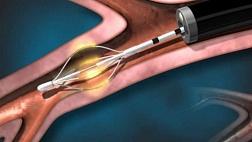 Бронхотермопластика