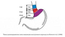 Классификации кардиоэзофагеального рака Аденокарцинома пищеводно-желудочного перехода по Зиверту J.R.Siewert