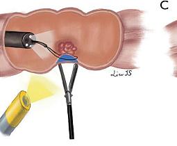 Комбинированные эндолапароскопические операции при сложных доброкачественных колоректальных полипах