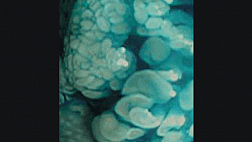 Эндоскопическая диагностика полипов толстой кишки