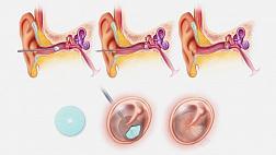 Учеными из Гарварда разработан протез барабанной перепонки PhonoGraft распечатываемый на 3d принтере