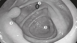 Нерешенные аспекты поиска и удаления плоских эпителиальных образований толстой кишки
