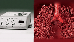 Бронхиальная термопластика