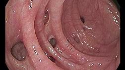 Классификация дивертикуллитов толстой кишки Hinchey E.J. (1978), Hansen O., Stock W. (1999), Классификация дивертикулярной болезни ГНЦК