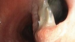 Трахеопищеводный свищ