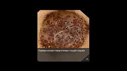 Кавернозная гемангиома тощей кишки как источник рецидивирующего кишечного кровотечения у ребёнка 11 лет