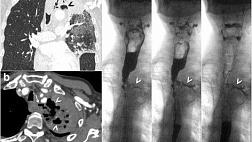 Классификация дисфагии по А. И. Савицкому