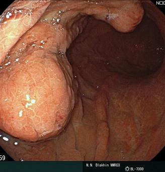 MALT-лимфома желудка.. Атлас эндоскопических изображений endoatlas