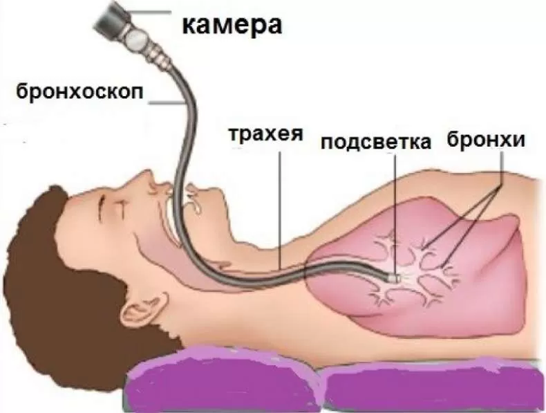 Бронхоскопия