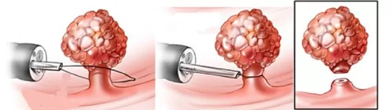 Удаление полипов в кишечнике