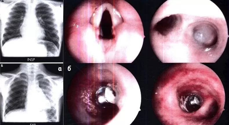 Инородные тела трахеи и бронхов у взрослых