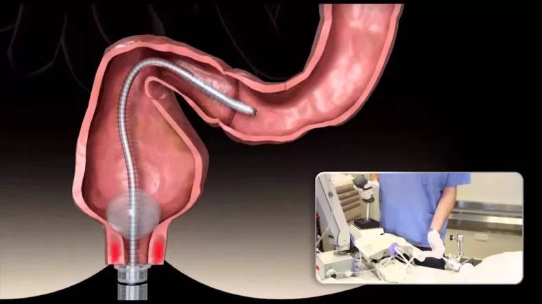 Сколько метров шланг колоноскопа
