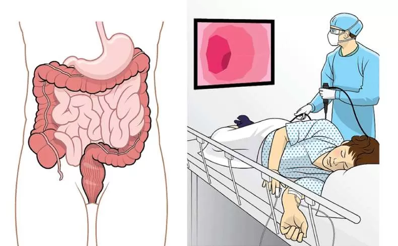 Показания к проведению колоноскопии