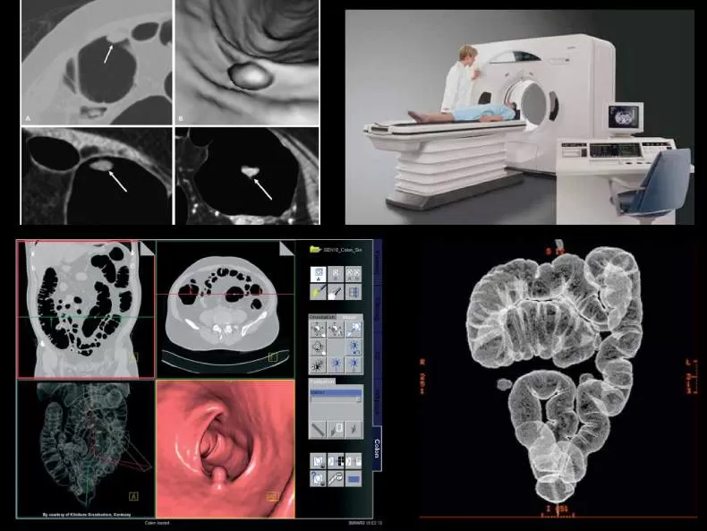 Виртуальная колоноскопия