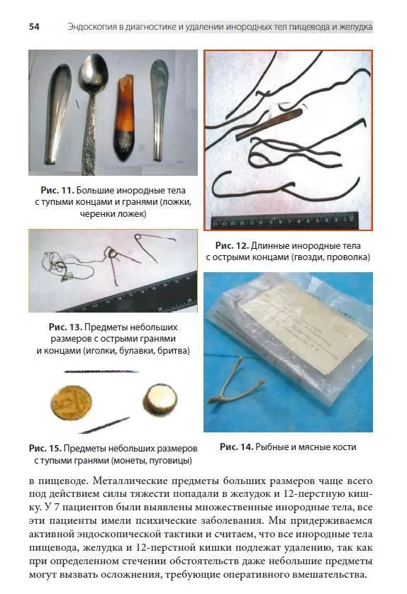 Эндоскопия в диагностике и удалении инородных тел пищевода и желудка, СИМК, 2022