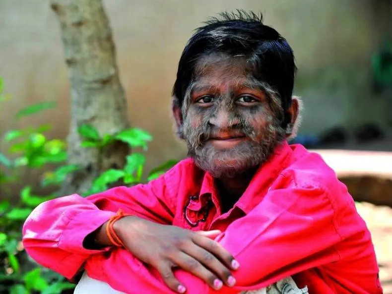 гипертрихоз