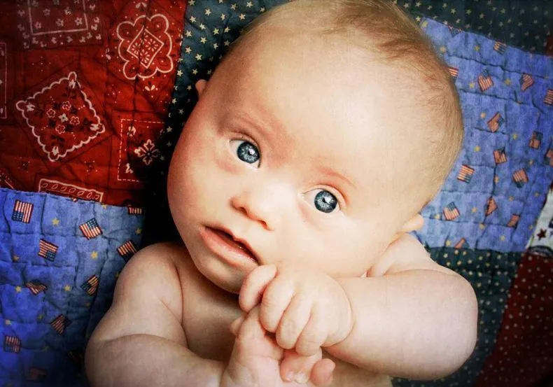 синдром Дауна