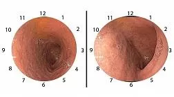 Правильная эндоскопическая ориентация в двенадцатиперстной кишке (ДПК)