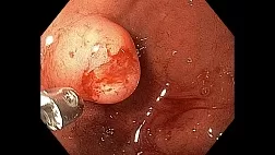 Нейроэндокринная опухоль двенадцатиперстной кишки, grade 2