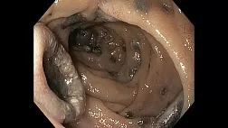 Метастазы меланомы двенадцатиперстной кишки