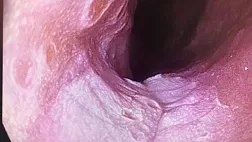 Поражение пищевода вирусной этиологии