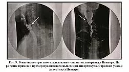 Диагностика и лечение дивертикулов Ценкера