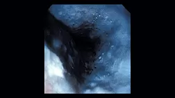 Химические ожоги пищевода: степени, симптомы