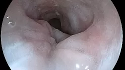 Пищеводно-плевральный свищ на фоне ахалазии кардии