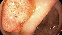 Аденокарцинома на фоне аденоматозного полипа сигмовидной кишки