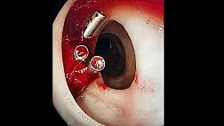 Cлучай кишечного кровотечения из дивертикула ободочной кишки.