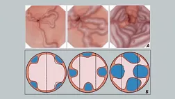 Классификация варикозно расширенных вен пищевода по Шерцингеру, N.Soehendra, K.Binmoeller. Baveno