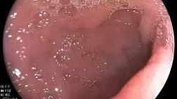 Дуоденальная дистрофия - гетеротопия ткани поджелудочной железы в стенку ДПК. Groove pancreatit.