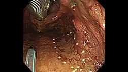 Эндоскопическая диссекция подслизистой оболочки при поверхностном раке глотки с использованием трансназального эндоскопа