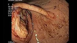 Воспалительная миофибробластическая опухоль желудка, осложненная кровотечением