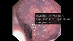 Ведение ректального варикоза при портальной гипертензии