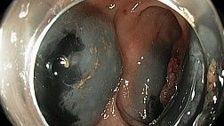 Эндоскопический татуаж образований толстой кишки и лапароскопическая хирургия. Технические аспекты и рекомендации