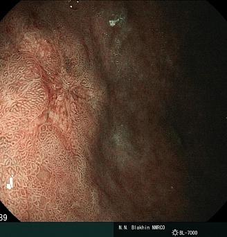 ранний рак желудка.. Атлас эндоскопических изображений endoatlas