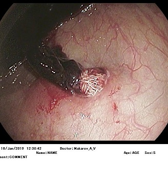 Ятрогенное повреждение толстой кишки (марлевый тампон). Атлас эндоскопических изображений endoatlas